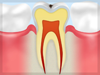 C0【ごく初期の虫歯】