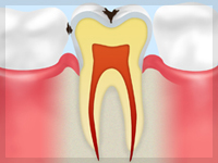 C1【エナメル質の虫歯】