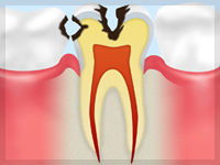 C2【象牙質の虫歯】