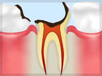 C4【歯根まで達した虫歯】