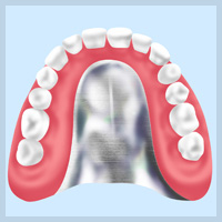 金属床義歯
